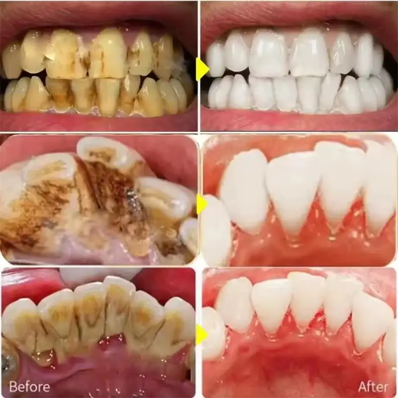 Stylo dentifrice à blanchiment - Whitening Pen Bleach avis et prix