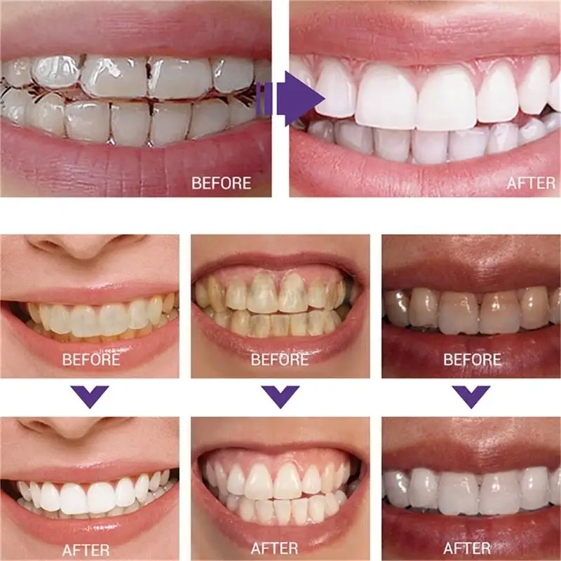 Stylo dentifrice à blanchiment - Whitening Pen Bleach avis et prix